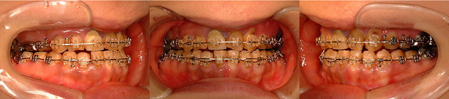 口唇口蓋裂の治療例　左側唇顎口蓋裂に起因する顔面非対称を呈する骨格性下顎前突　顎矯正手術１か月後　口腔内